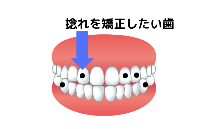 インビザラインの矯正ポイント