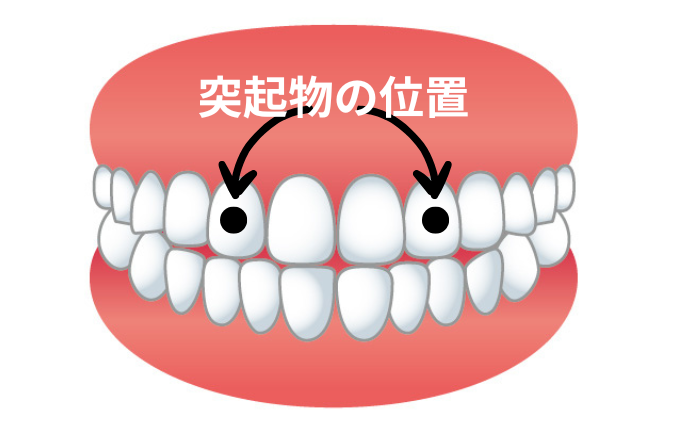 マウスピースから置き去りにされた歯の新しい矯正